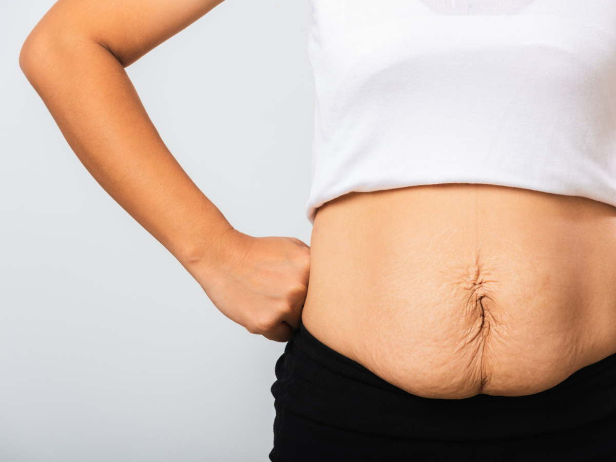 How To Lose Weight After A C-Section